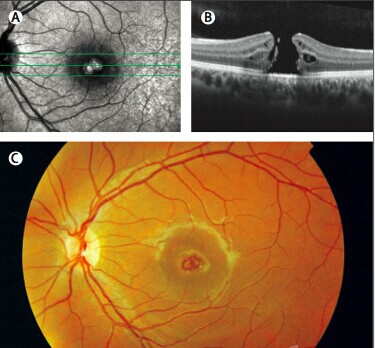 该患者的自发荧光照片(a),oct 检查结果(b)以及彩色眼底照片(c)显示