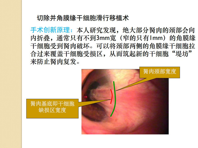 > 翼状胬肉手术美容原则