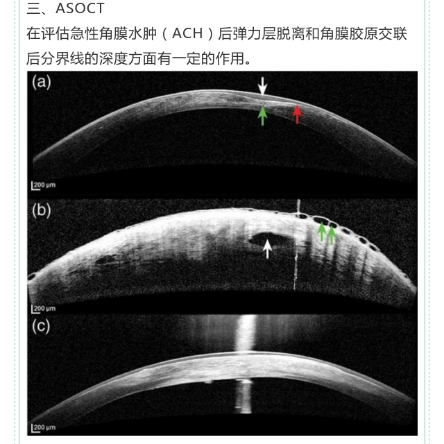 【郭海科 眼科继教】圆锥角膜——之急性角膜水肿_中国眼科网_www.