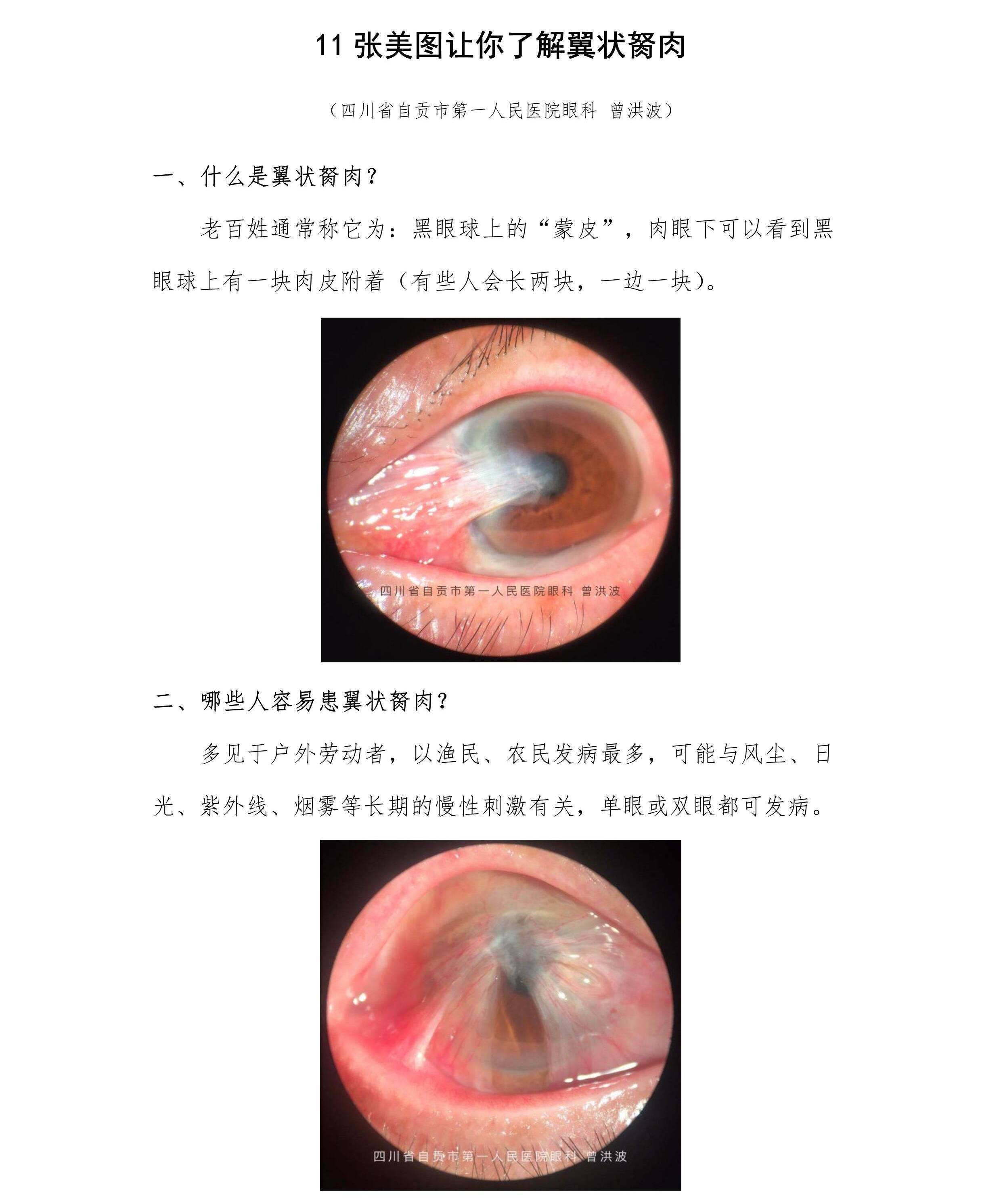 11张美图让你了解翼状胬肉 | 临床图解四_www.yanke.