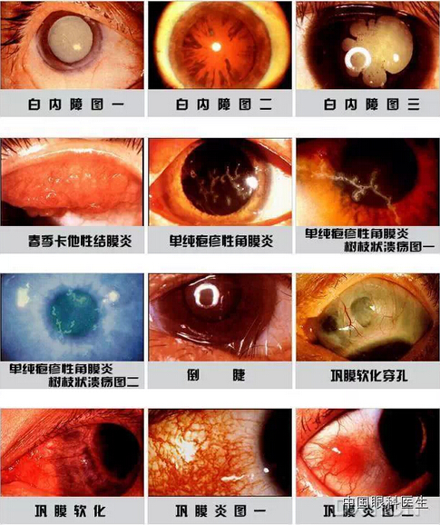 18种常见眼科疾病图片