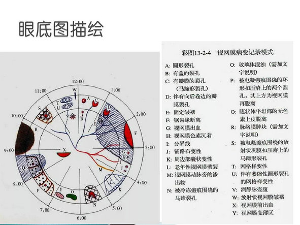 房角镜及三面镜检查 中国眼科网 Www Yanke360 Com